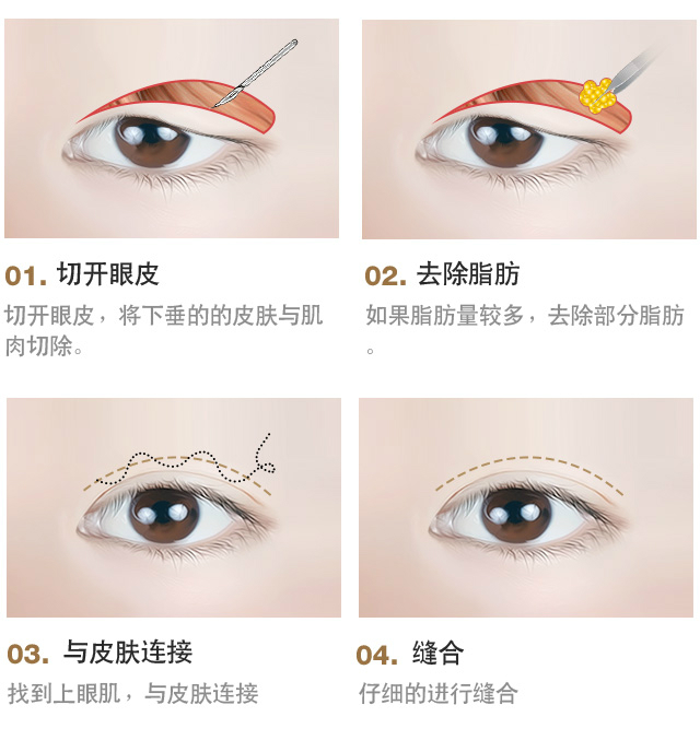 上眼睑