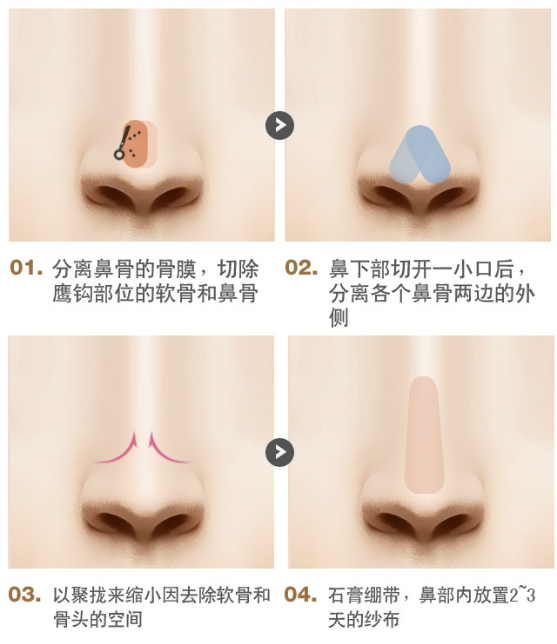 Config Subject 鼻部整形 鼻型矫正 鹰钩鼻