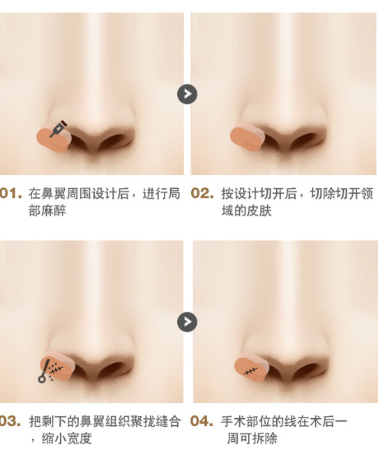鼻翼缩小术（鼻孔缩小术）
